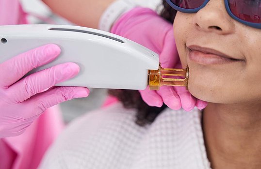 Co2 Laser Treatment | Elation