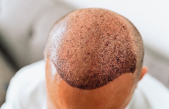 Hair Transplant | Elation
