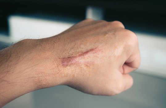 Scar Removal | Elation<br />
