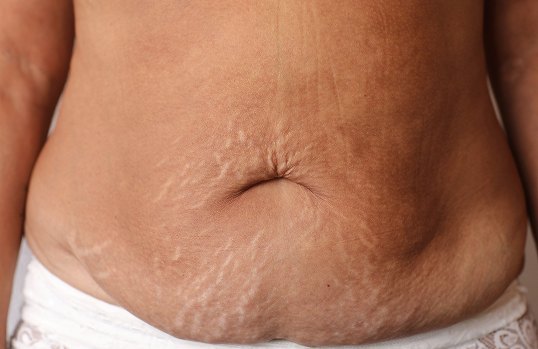 Stretch Marks Removal | Elation<br />
