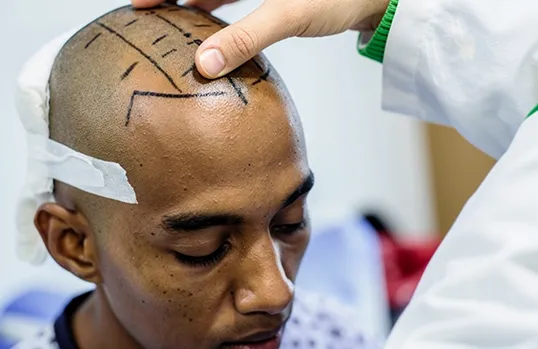 Hair Transplant surgery