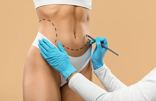Liposuction (abdomen)
