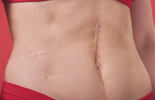 Scar Mark Revision Surgery