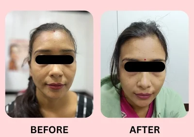 Treatment Result