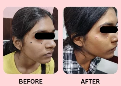 Treatment Result